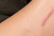 Biaya Suntik Keloid Terbaru, Apa Saja Manfaat dan Risikonya
