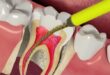 Harga Perawatan Saluran Akar Gigi Terbaru