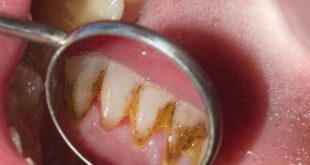 Tips Memilih Obat Kumur untuk Hilangkan Karang Gigi
